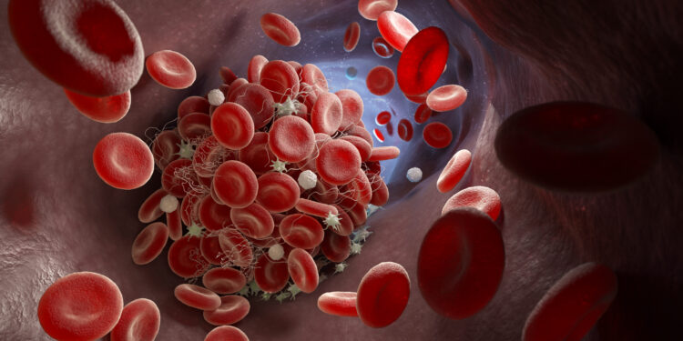 Depiction of a blood clot forming inside a blood vessel. 3D illustration